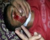 مجروح شدن شهروندان بحريني با گلوله هاي ساچمه اي و درمان آنها در منازل