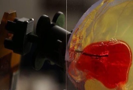 مکش لخته خون از مغز با ابر سوزن رباتیک!