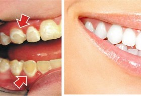 ترفندهایی که دندان‌هایتان را مثل مروارید سفید می‌کند