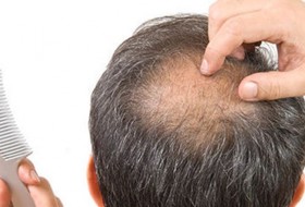 علل «ریزش مو» چیست؟